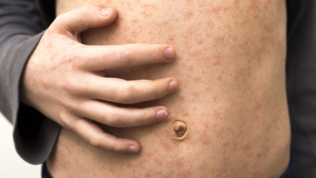 Measles Outbreak Escalates in Texas and Spreads to New Mexico