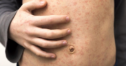 Measles Outbreak Escalates in Texas and Spreads to New Mexico