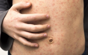 Measles Outbreak Escalates in Texas and Spreads to New Mexico