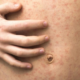 Measles Outbreak Escalates in Texas and Spreads to New Mexico
